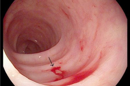 Giảm xuất huyết